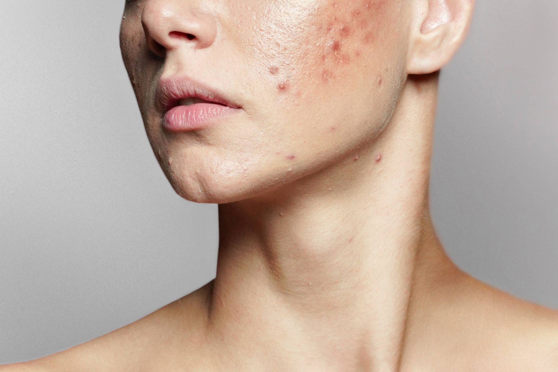 ceravemacchie-post-acne-come-ridurle